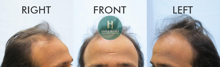 Before Procedure 2800